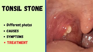 Tonsil stone | Cause, symptoms, treatment & photos