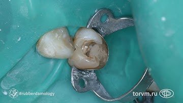 #rubberdamology TorVM Matrix Aplication 011 ENG