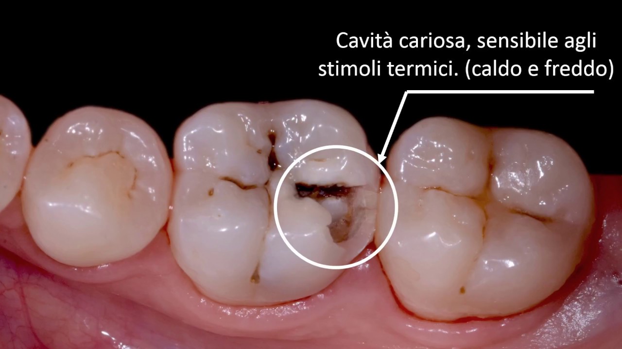 Otturazione Colletto Dentale Prima E Dopo Otturazione in composito - YouTube