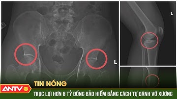 Công an Phú Thọ triệt phá đường dây tự đục vỡ xương khớp trục lợi bảo hiểm | ANTV