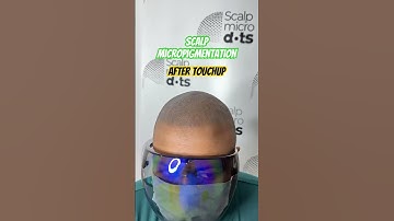 Magic of scalp micropigmentation in 🇮🇳 India, 8891426652 8078800335 #scalpmicropigmentation #smp