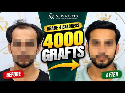 His Hair Transformation Took 2 Years… But LOOK at the Result! 😍 | Hair Transplant in Kolhapur