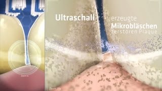 So funktioniert die Zahnreinigung mit echtem Ultraschall - emmi-dent