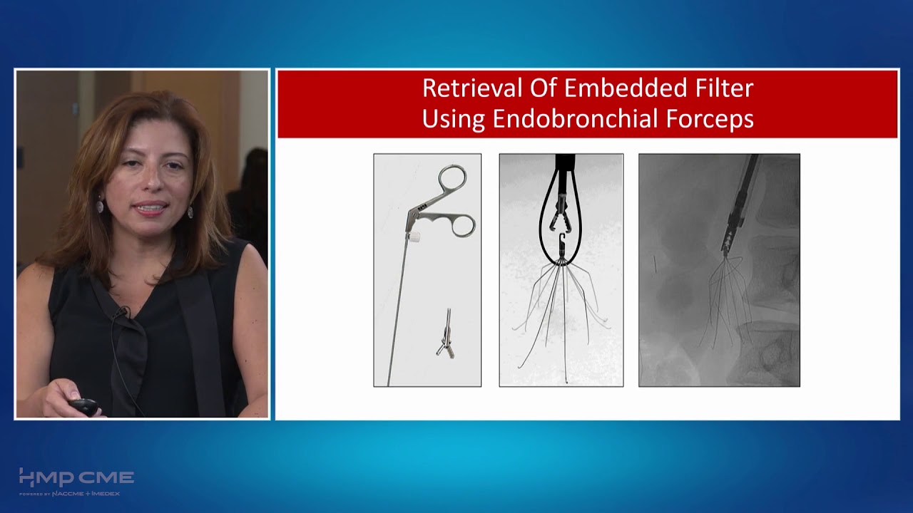 Ivc Filter Retrieval: Best Practices From Standard To Complex