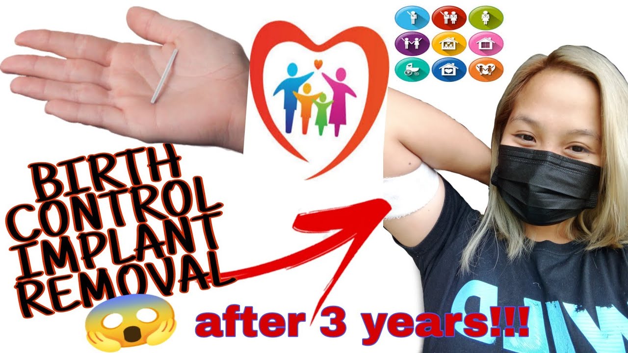 Implant Removal "IMPLANON"(after 3 years).family familyplanning 