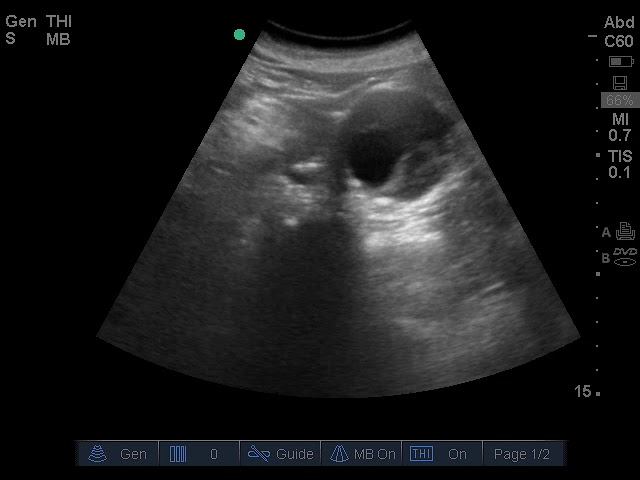 aaa transverse clip lots mural thrombus crop