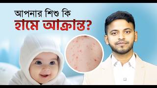 আপনার শিশু কি হামে আক্রান্ত? । সমসাময়িক | ছাত্র সংবাদ।
