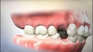 Removing Teeth for #braces   Extracting and Retracting #orthodontics is harmful #thishappenedtome