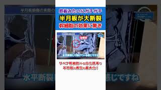 半月板損傷】大断裂！鉄板のようにカチカチになった膝を再生医療で治療