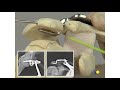AO Lateral Clavicle—Dislocations and Fractures—The LCP Clavicle Hook Plate