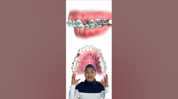 ¿Te SACARÁN MUELAS para ponerte BRACKETS? 😱😏