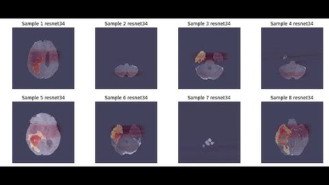 Linknet 3D Brain Tumor Segmentation and Classification Tensorflow | UNET | +91-9872993883 for query