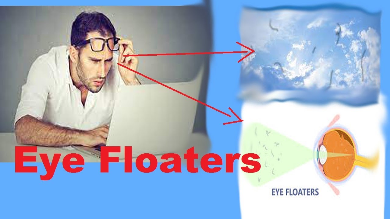 Eye Floaters YouTube