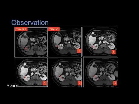 MRI pre and post liver transplant