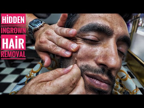 ASMR Barber Transformation | Close-Up Haircut, Head Massage & Hidden Ingrown Hair Removal