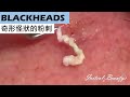 深層黑頭粉刺(blackheads) - Taiwan Tainan台南清粉刺最乾淨