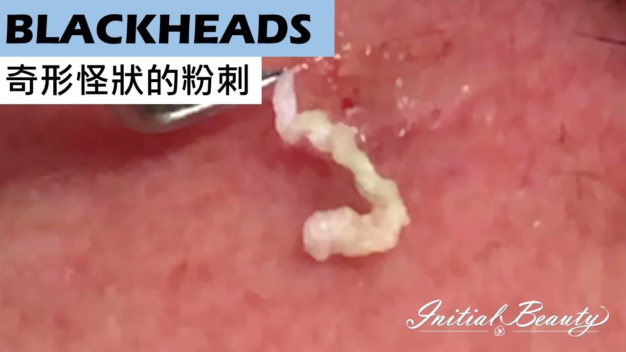 Squeezing long blackheads