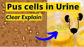 Pyuria: Pus cells in urine-2 - YouTube