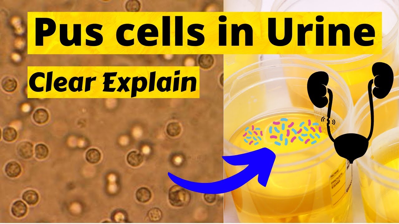 قراءة تحليل مزرعة البول cells pus