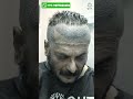 Milind Gunaji Hair Transplant Result Latest Fue Technique Shorts Viral Hair Transplant 