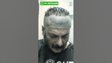 Milind Gunaji Hair Transplant Result | Latest Fue Technique #shorts #viral #hair transplant
