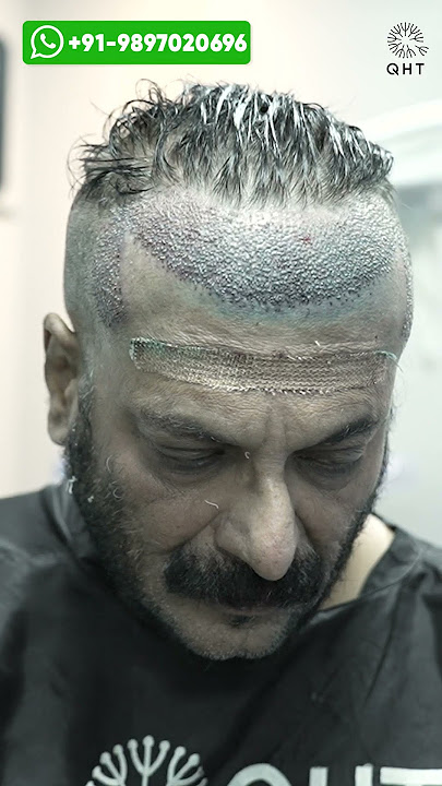 Milind Gunaji Hair Transplant Result | Latest Fue Technique #shorts #viral #hair transplant