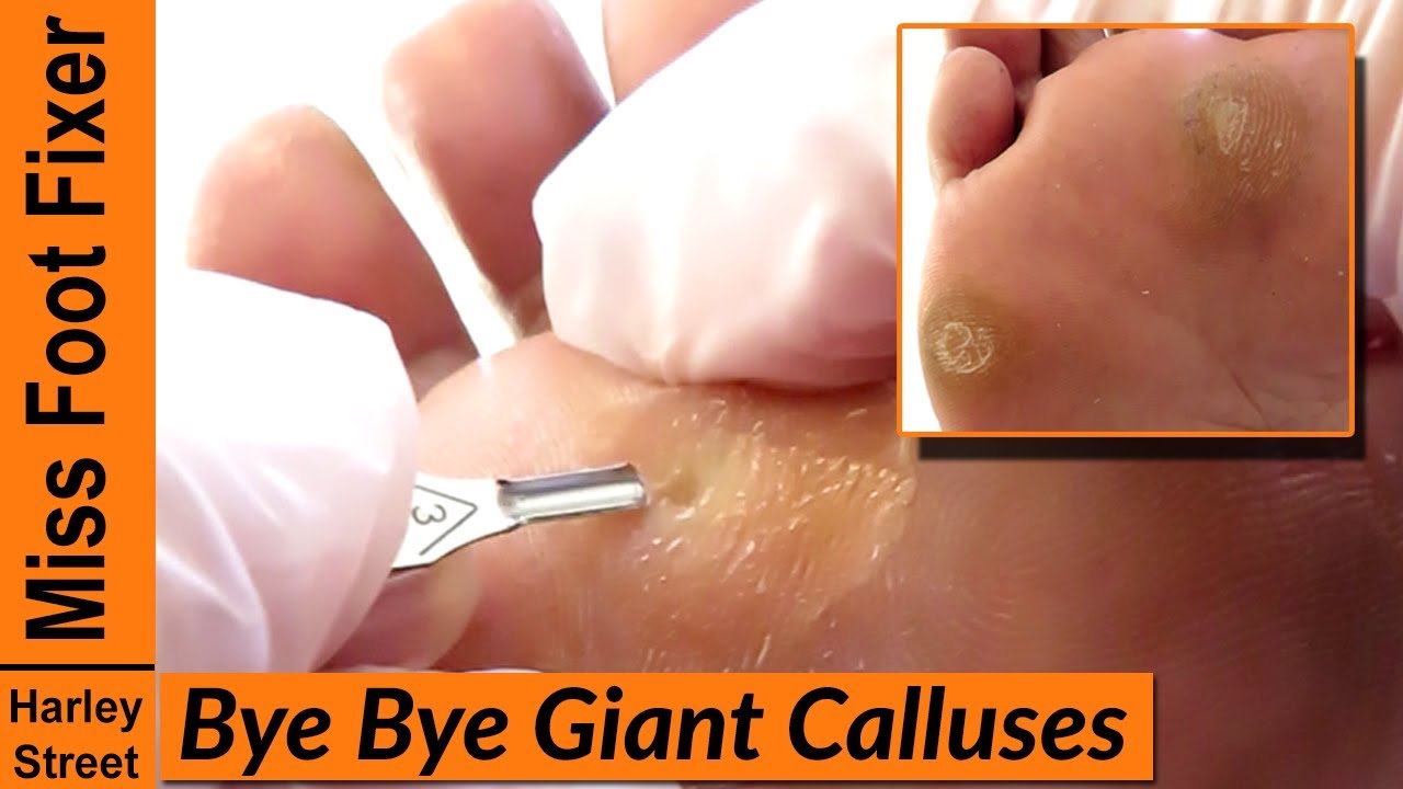 SATISFYING THICKEST AND GIANT CALLUSES REMOVAL BY MISS FOOT FIXER 