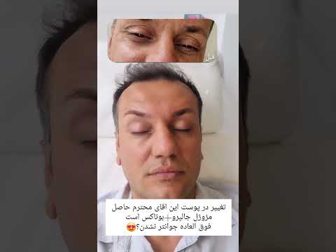 مزو بوتاکس یک ترکیب برنده اگر شما هم همچین تغییری میخواین میتونین با شماره ۰۹۰۲۹۳۸۳۴۹۱ تماس بگیرین