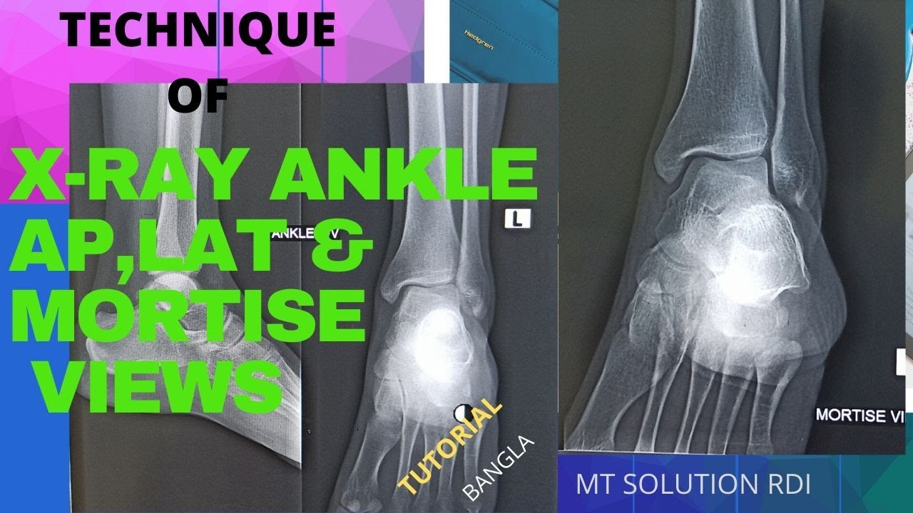 Computed tomography of the heel region. (A) Axial view showing the... |  Download Scientific Diagram