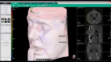 Airway Analysis | Ez3D-i | Vatech