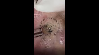 Best ear blackhead removal