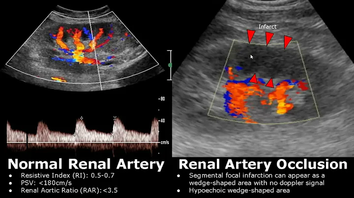 Renal Artery Doppler Ultrasound Normal Vs Abnormal Images | Stenosis/Occlusion/AVM | Kidney USG - DayDayNews