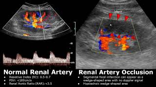 Renal Artery Doppler Ultrasound Normal Vs Abnormal Images | Stenosis/Occlusion/AVM | Kidney USG
