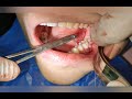How to extract wisdom tooth by drmohamed elshamaa