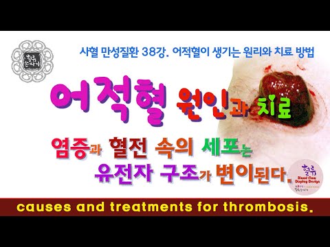 사혈 만성질환 38강. 어적혈이 생기는 원리와 치료 방법, 혈전 제거와 사혈의 방법. causes and treatments for thrombosis.