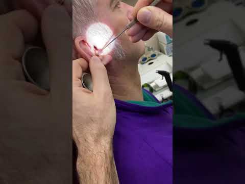 Видео: Как удалить ушную серу из слухового аппарата (с иллюстрациями)