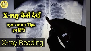 Xray reading | How To Read Chest X-ray In Hindi | Xray interpretation