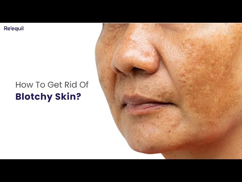 Video: Is een vlekkerige huid normaal?