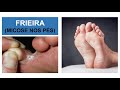 MICOSE NOS PÉS (Frieira) - Como combater? Por Luiz Gameiro, dermatologista