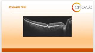 OCT Interpretation Session 5 Subretinal and RPE Disease