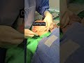 (2025.02.27) Dr.Kirk@Nerve-Preserving Contour Surgery #shorts