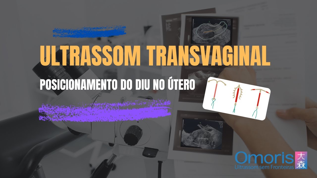 Ultrassom Diu Paragard
