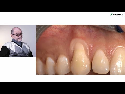 Video: I gingival blödningsindex?