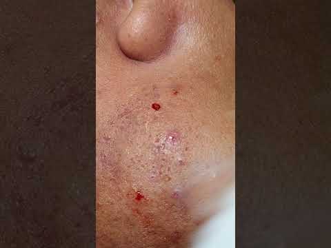 Video Mụn Viêm và Mụn Đầu Đen_AlìnSpa(42)#trịmụnantoàn... - youtube