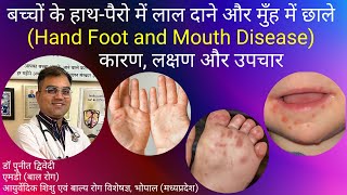 Hand Foot And Mouth Disease Treatment | डॉ पुनीत द्विवेदी