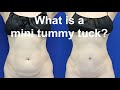 Benefits Of The Mini Tummy Tuck in Beverly Hills - Dr. Dass