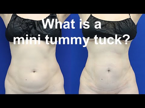 What is a Mini Tummy Tuck?