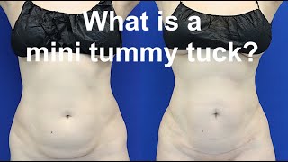 Benefits Of The Mini Tummy Tuck in Beverly Hills - Dr. Dass