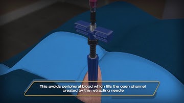 Medical animation - Optimized Bone Marrow Harvesting for Regenerative Therapies