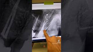 Root canal therapy of tooth #14 in one visit.